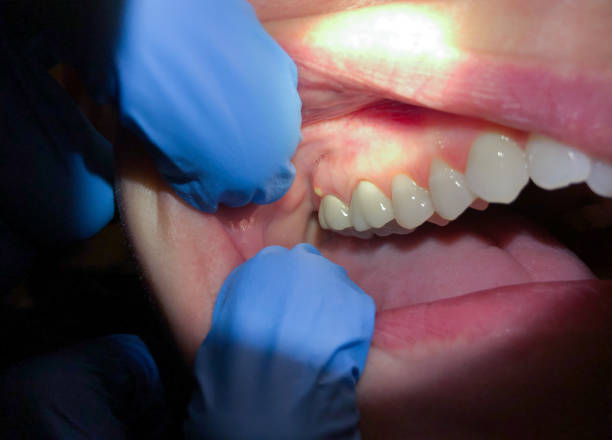 Best Emergency Dentist for Knocked-Out Tooth in Woodstock, IL