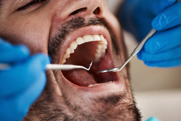 Best Emergency Dentist for Lost Fillings or Crowns in Woodstock, IL